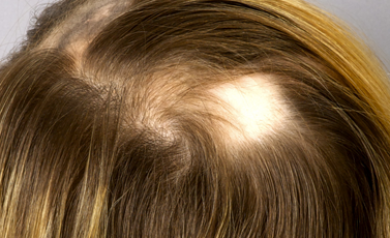 Alopecia Areata Diagnosis