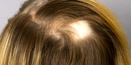 Alopecia Areata Diagnosis