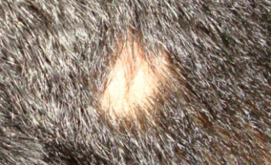 Alopecia Areata Causes