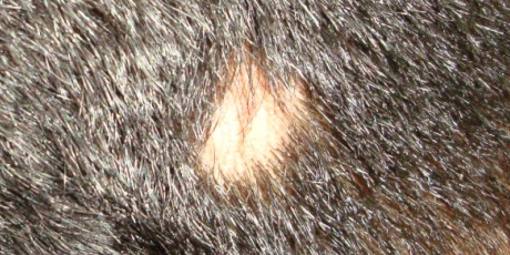 Alopecia Areata Causes