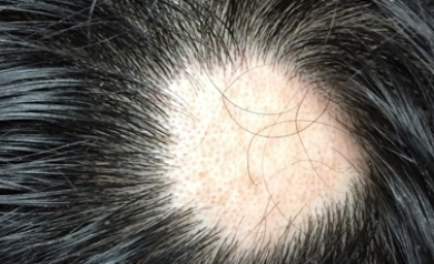 Alopecia Areata Symptoms