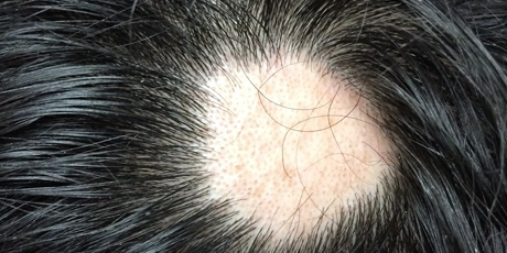 Alopecia Areata Symptoms