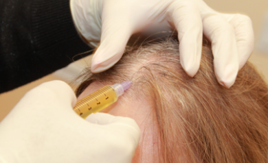 alopecia areata treatment