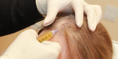 alopecia areata treatment