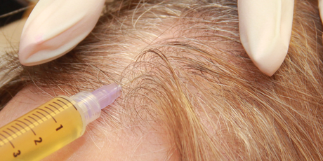 hair loss treatments