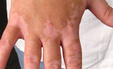 vitiligo symptoms