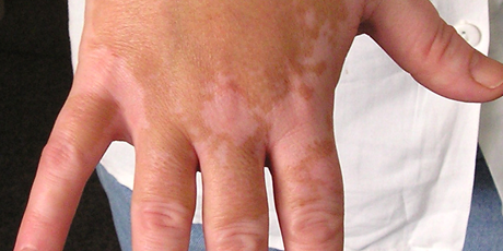 vitiligo symptoms
