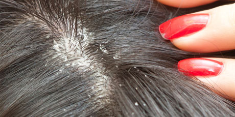 dandruff