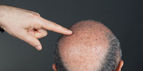 hair loss