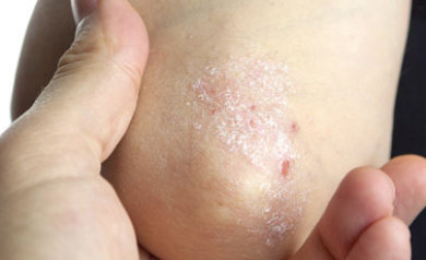 psoriasis