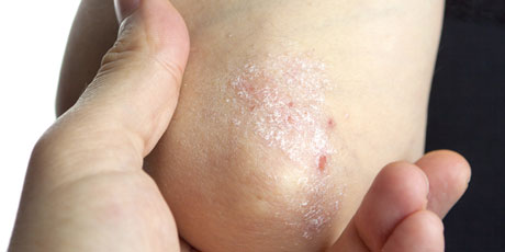 psoriasis