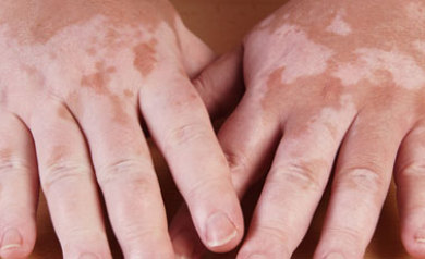 vitiligo