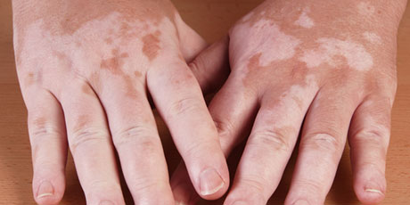 vitiligo