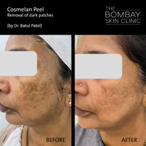 Cosmelan Peel Before After