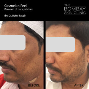 Cosmelan Peel Results