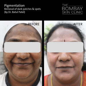 Cosmelan Pigmentation Results