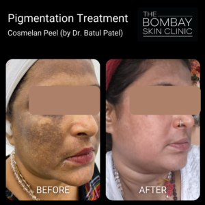 Cosmelan Peel Mumbai Results