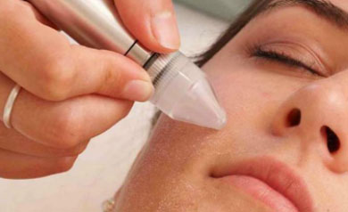 Microdermabrasion treatment for acne