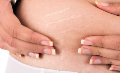 stretch mark removal