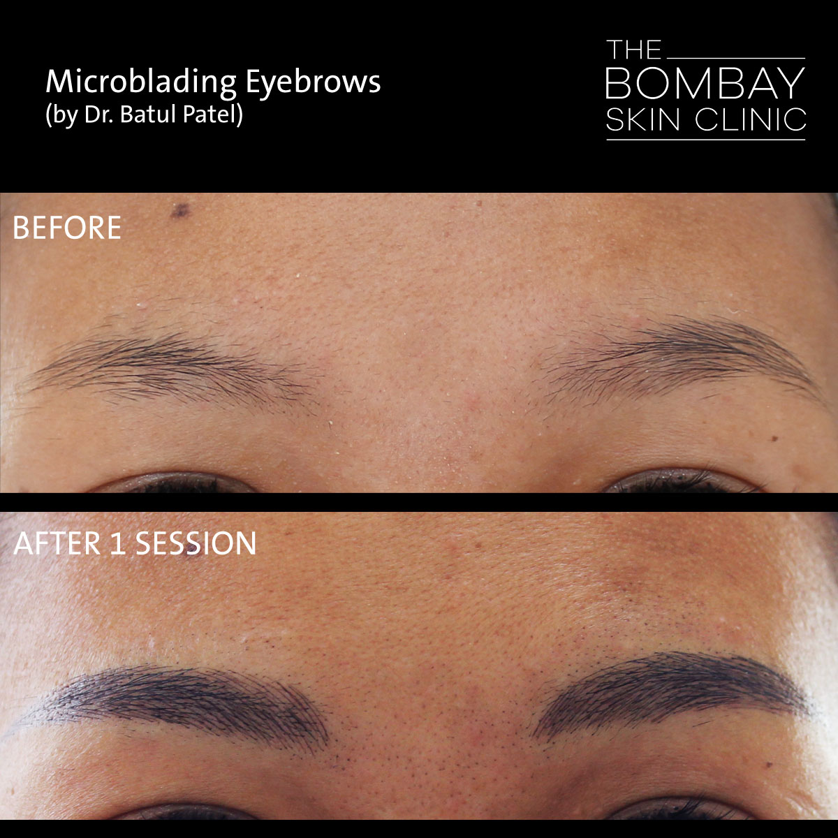 What is Microblading Eyebrows? - Overview, Costs & Risks | Dr. Batul Patel