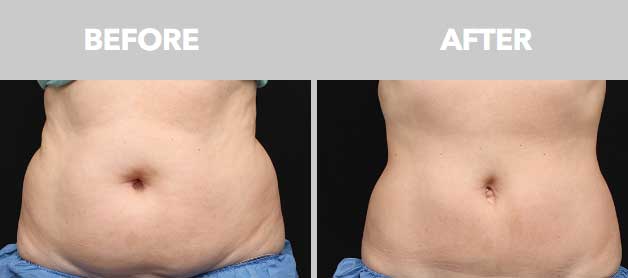 CoolSculpting Before After 01