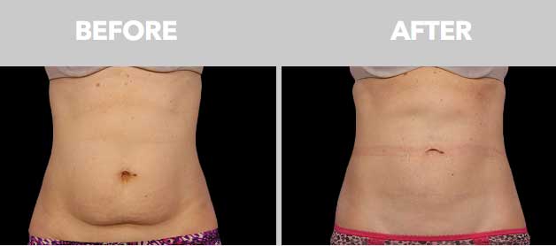 CoolSculpting Before After 02