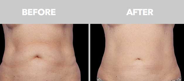 CoolSculpting Before After 05