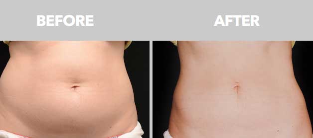 CoolSculpting Before After 06