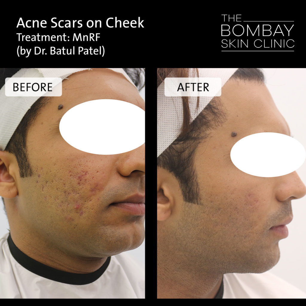 Acne scar treatment before after
