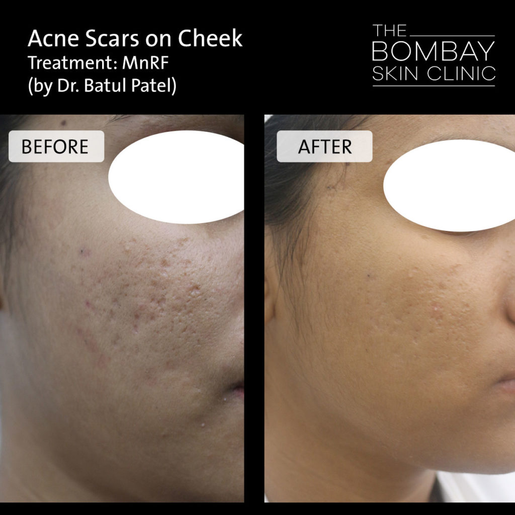 Acne scare before after photo