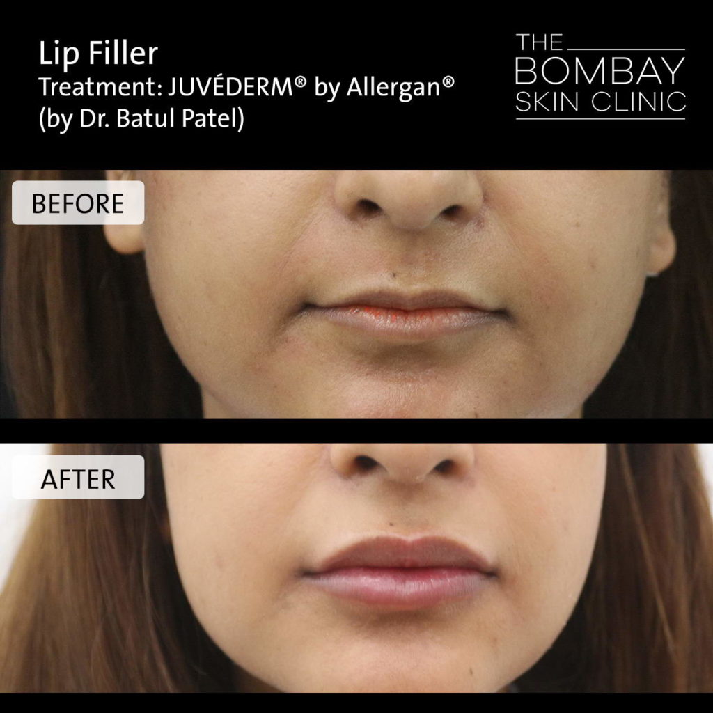 Face fillers treatment photos