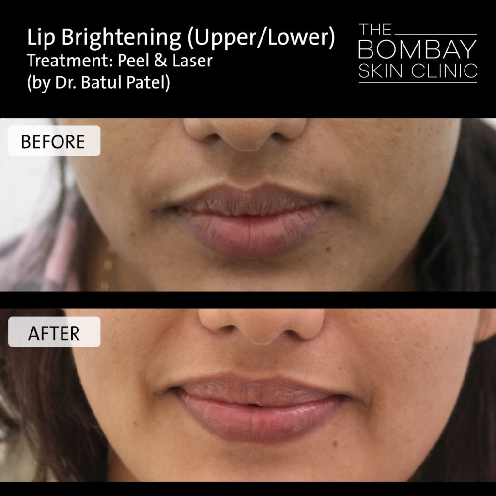 Lip brightening