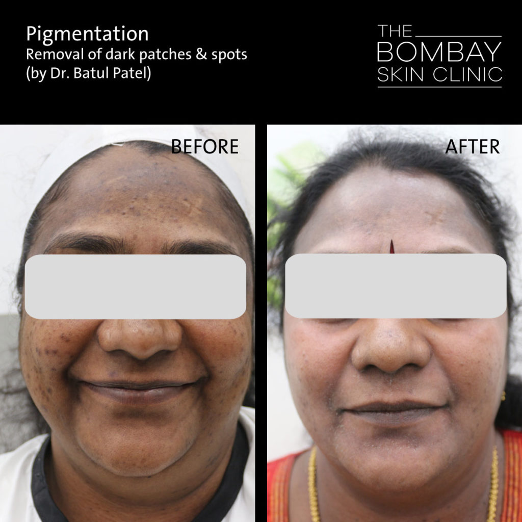 Pigmentation before after patient