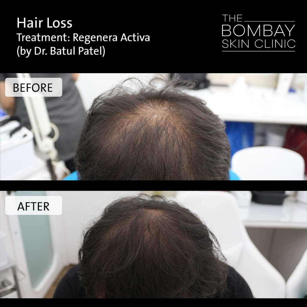 Regenera Hair Loss treatment