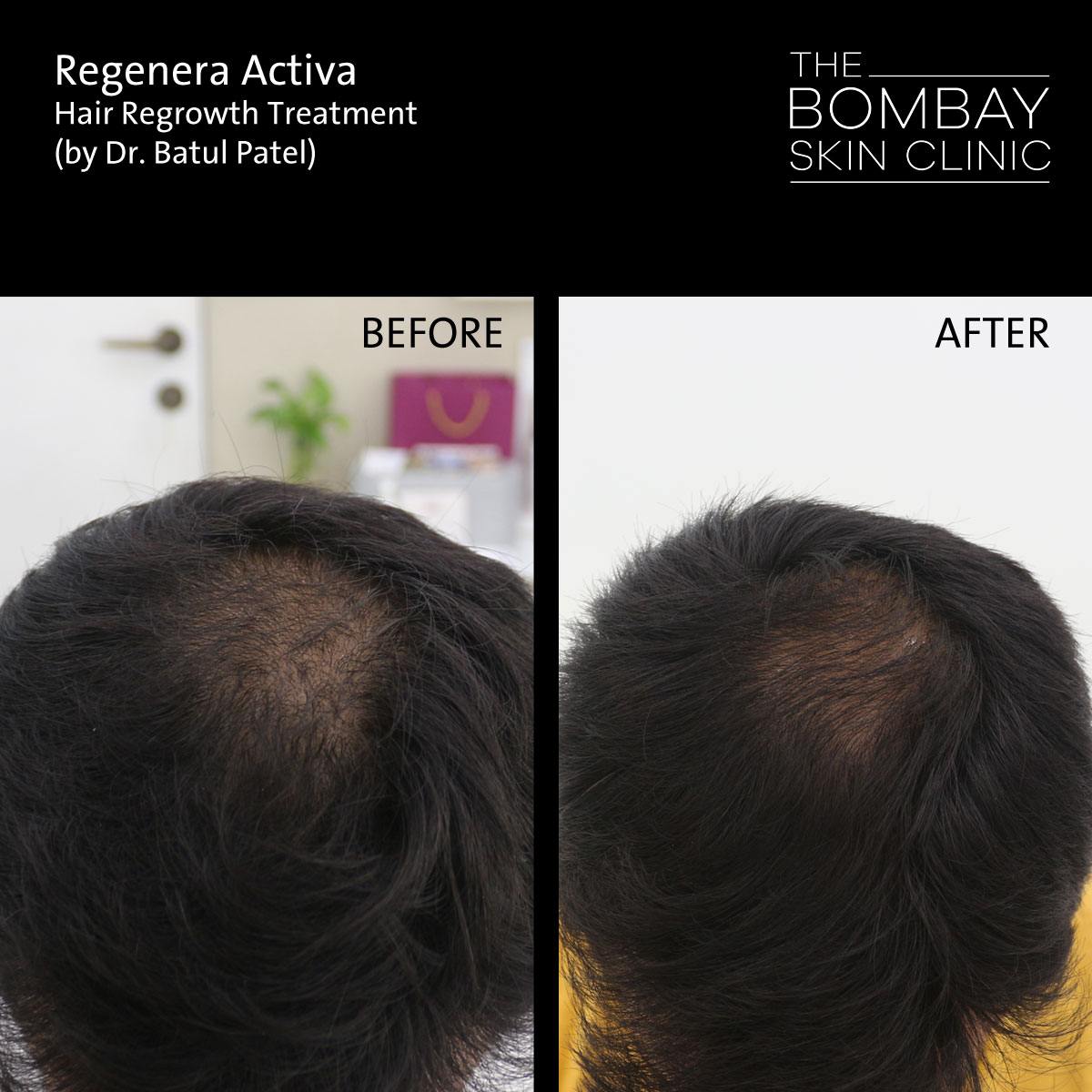 Regenera Hair Loss treatment