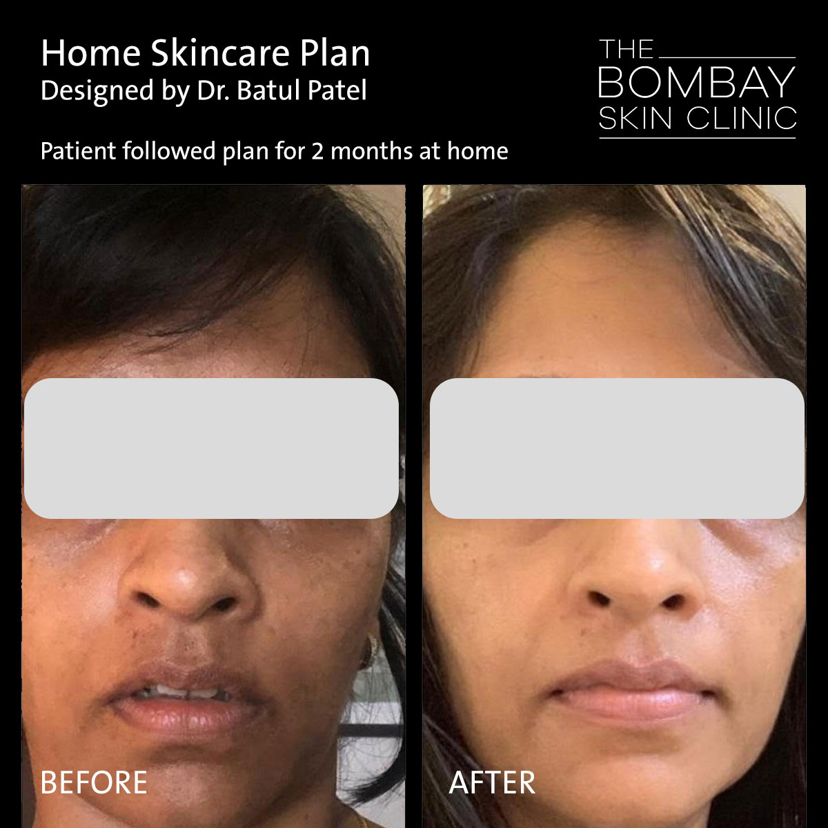 Before After Treatment Skin & Hair Treatment Photos | Dr. Batul Patel