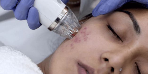 Acne Scar Treatment – Overview, Types, Benefits & Risks