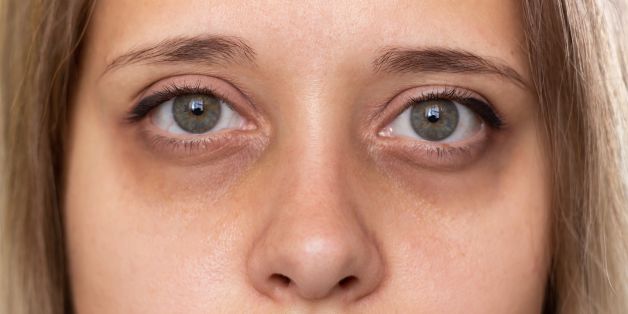 Sunken Eyes – Causes, Treatment Options, Results & Risks