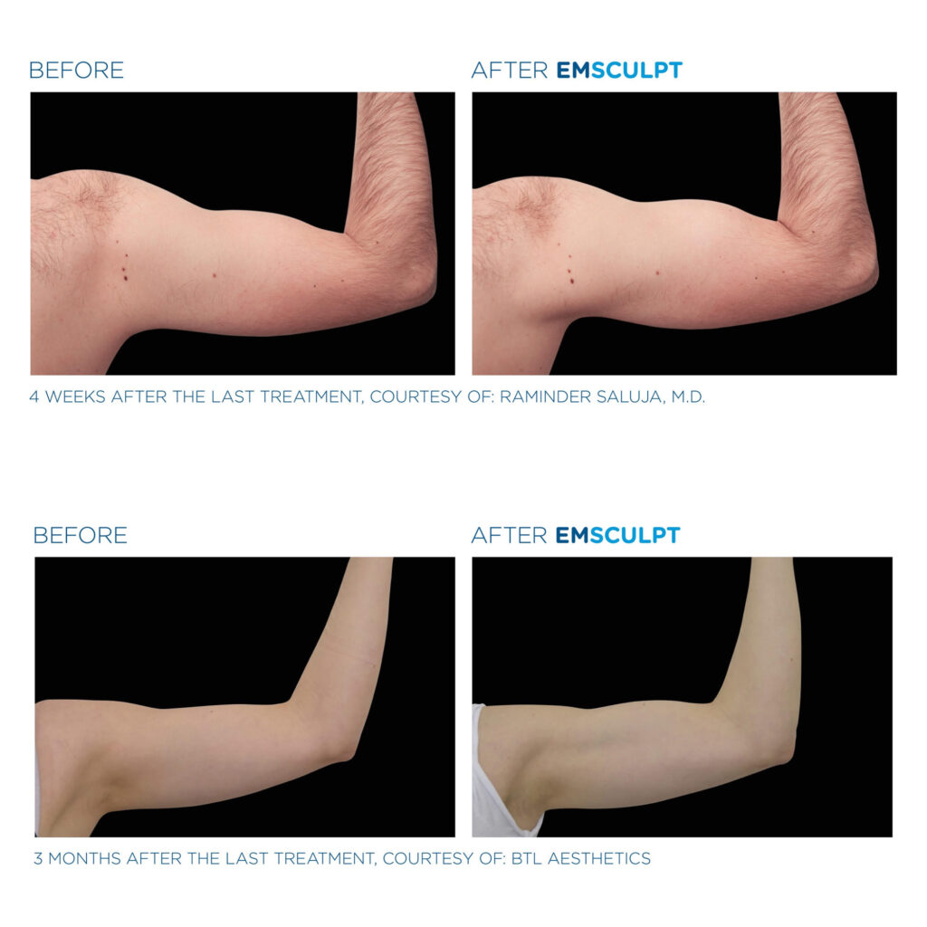 emsculpt before after bombay skin clinic