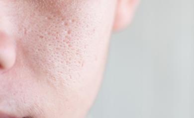 Open Pores Treatment