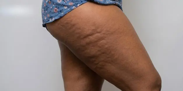 Cellulite_Treatment