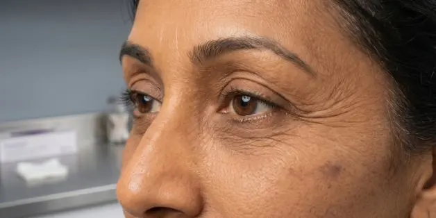 Wrinkle_Treatment