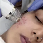 MnRF_Treatment